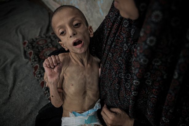 Nafez Mohammed Khidr Nasser, ten, can barely walk through starvation.