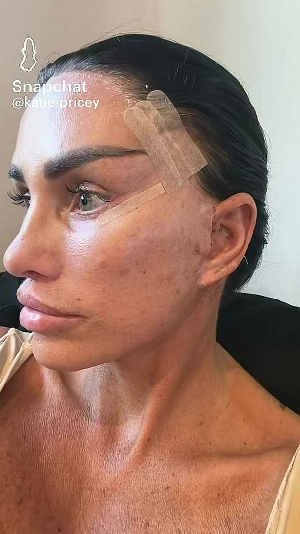 Katie Price shows off results of previous facelift surgery in bandages