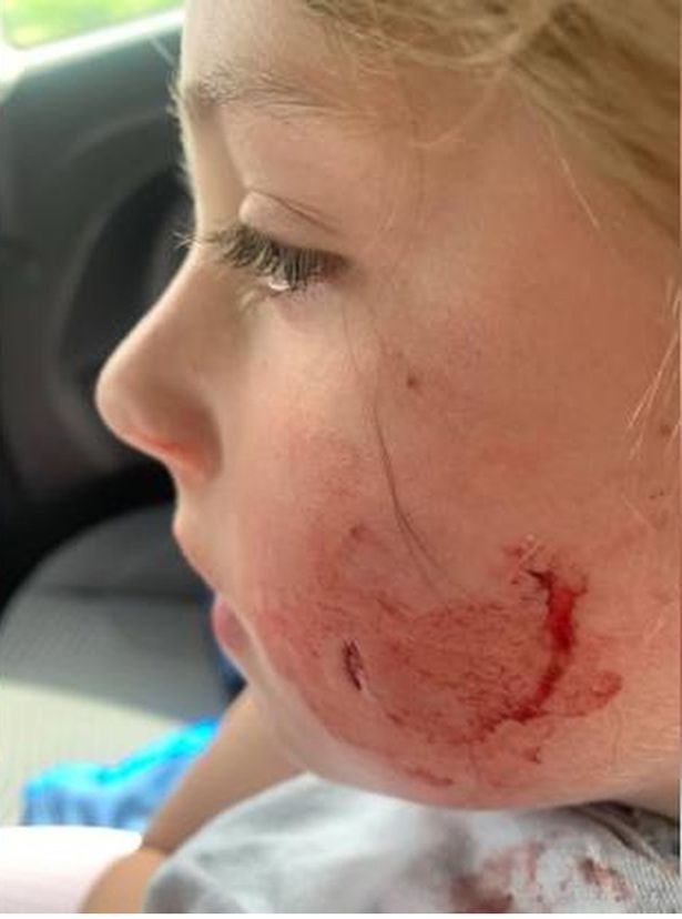 Kayla Watson's left cheek covered in blood