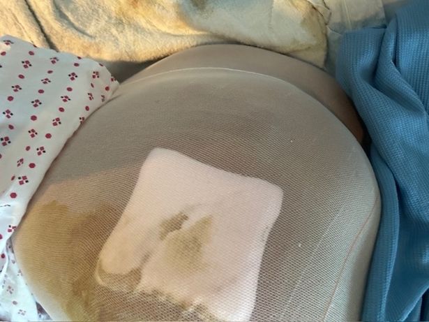 Sasha Dean went into multi organ failure when a liquid BBL went wrong