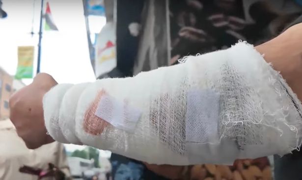 Mohammad's arm covered in a bandage after he was slashed on the hand and arm