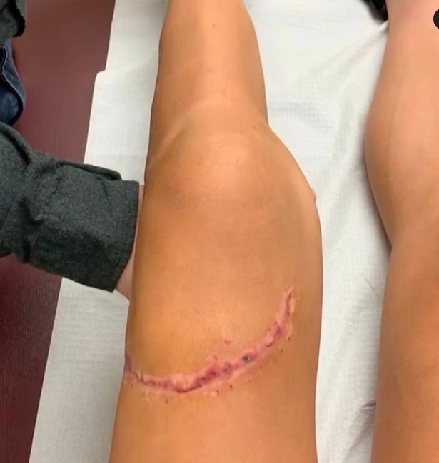 The scar that Chloe Dygert has been left with