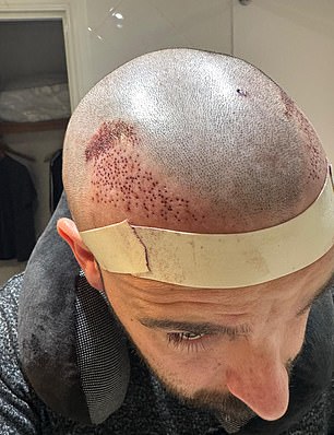 Michael was concerned the day after his hair transplant, as there was heavy scabbing and a gap between the implanted follicles and his own hairline