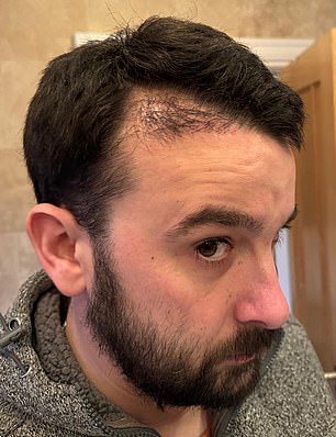 He was told by the clinic that the gaps in his hair would close as the hair grew