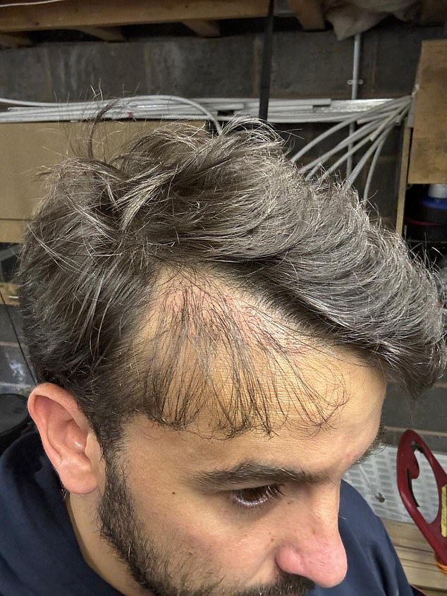 Hair transplant failure rates are not always openly published, partly because many clinics lack long-term follow-up data or are reluctant to disclose poor outcomes
