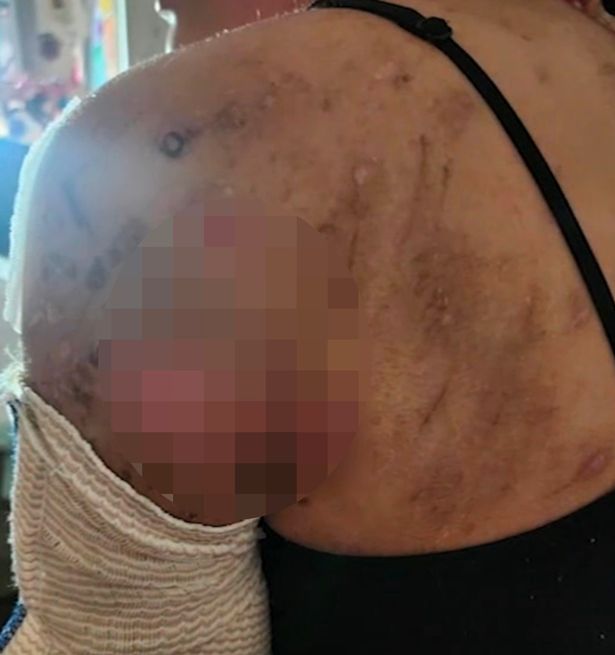 Injuries on Tracy's shoulder and back