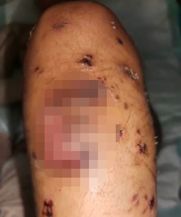 Injuries on Tracy's leg
