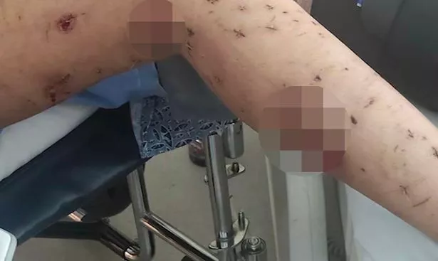 Injuries on Tracy's leg