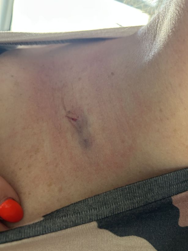 Natalie, from Warwickshire, underwent a biopsy on the lump on her neck
