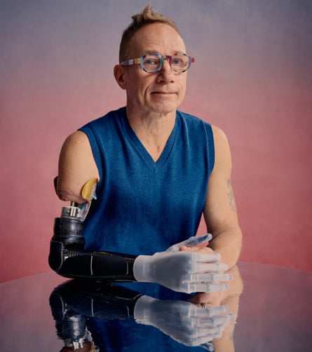 Jim Ashworth-Beaumont photographed in March 2025 with his new manually adapted prosthetic arm