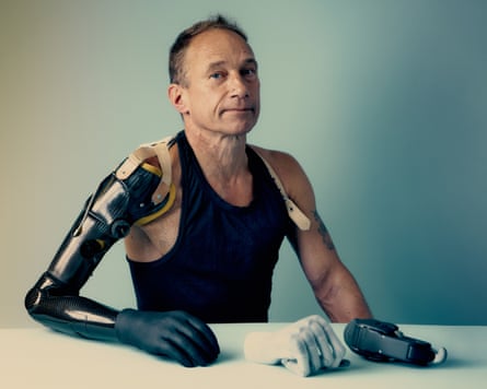 Jim Ashworth-Beaumont photographed with his previous prosthetic arm in October 2024
