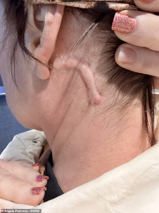 And 14 months after recovering, Angela said she still had scarring around her neck, a 'bunched-up eye' from tight stitches and lasting hearing loss in one ear