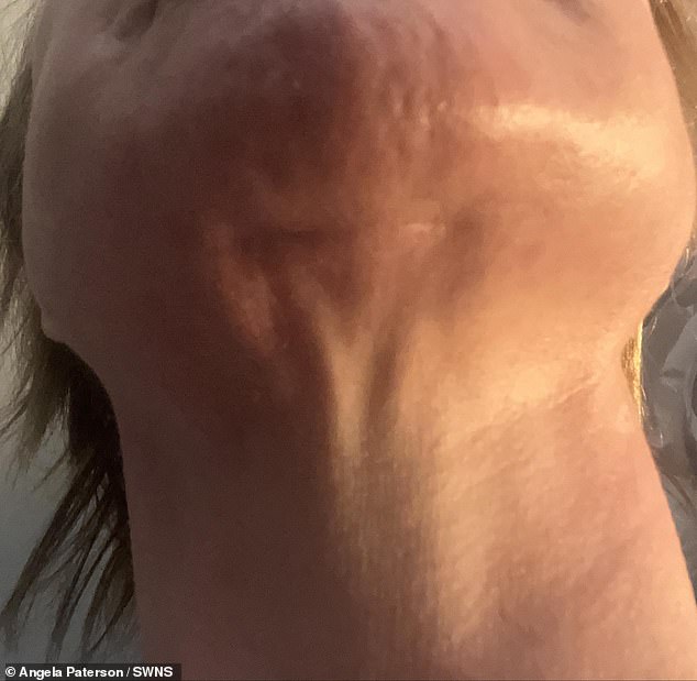 Six months after the operation, the clinic offered Angela revision surgery on her scars for £600