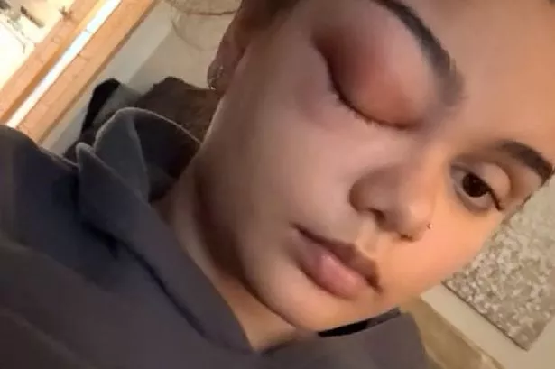 Sophie Bell with an inflamed eye