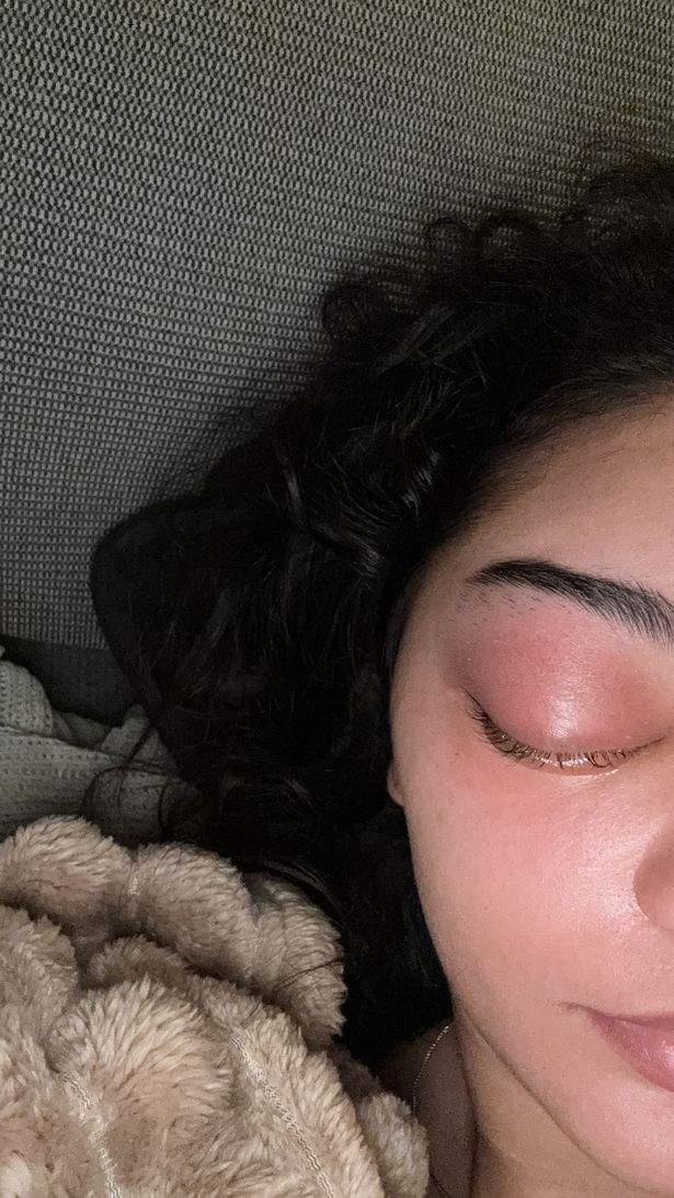 Left side of Sophie's face with swollen eye